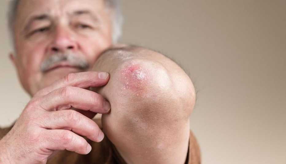 1140 psoriasis esp